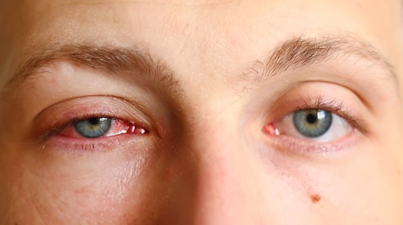 Allergic eye disorder treatment consultation