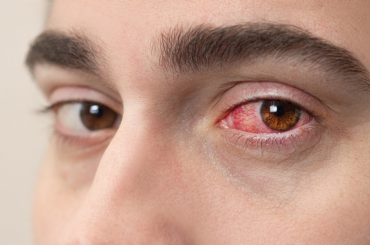 Treatment of Eye Inflammations
